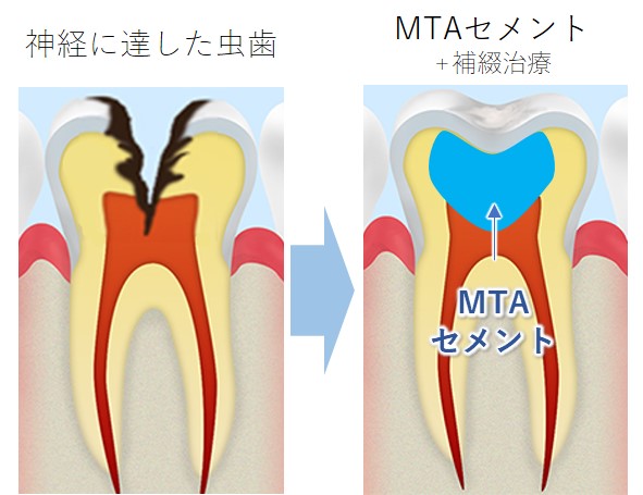 海老名市（社家駅）の歯医者、しゃけ駅前歯科のMTAセメント